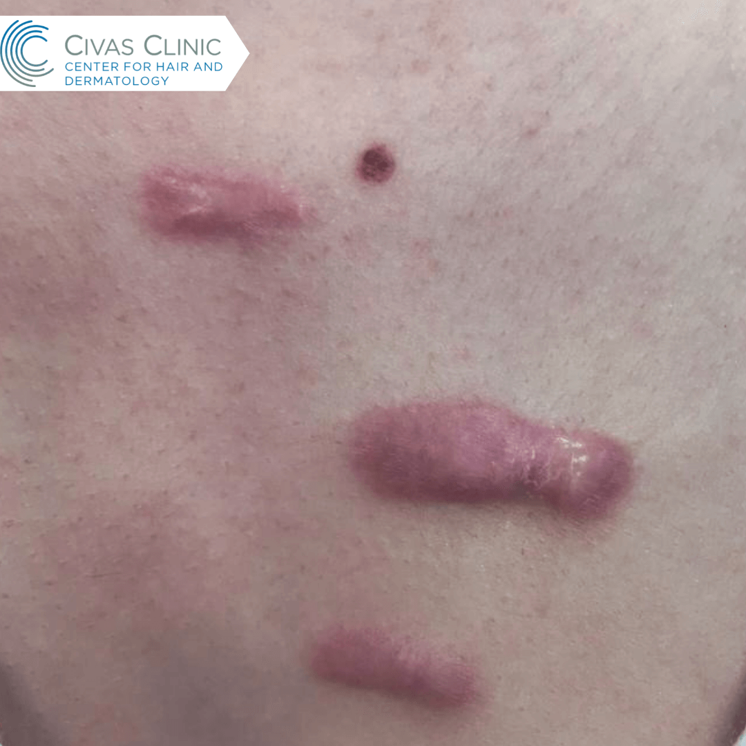 Keloid Yara Zi Tedavisi Do Dr Ekrem Civas Ankara Ayyolu