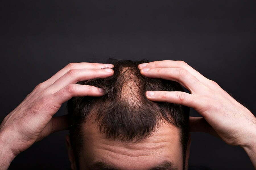 Saç Dökülmesi Neden Olur? Aşırı Saç Dökülmesi Sebepleri | Doç. Dr