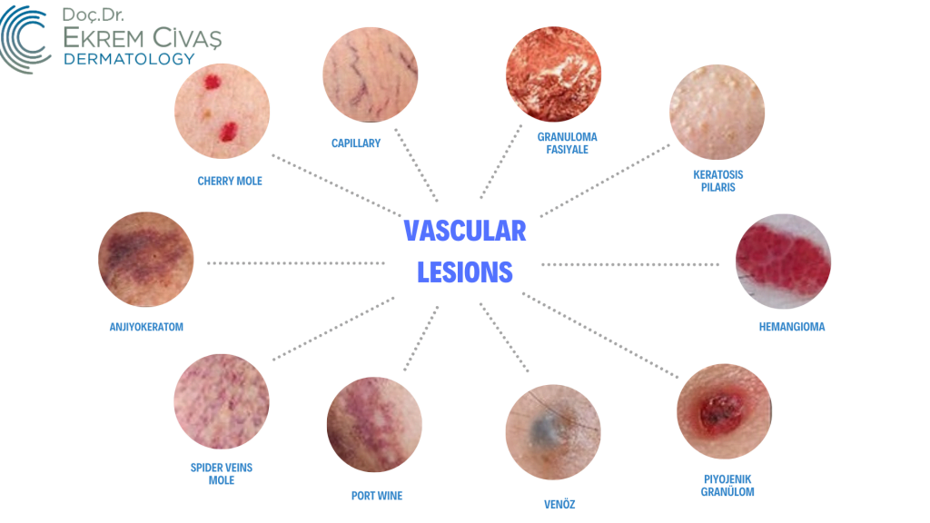 Vascular Lesions Doç Dr Ekrem Civas Dermatology