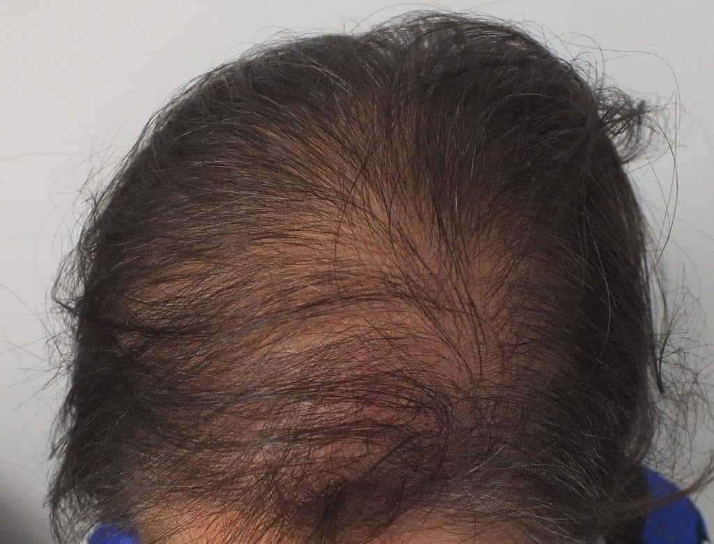 Hair Transplant For Women Doç Dr Ekrem Civas Ankara